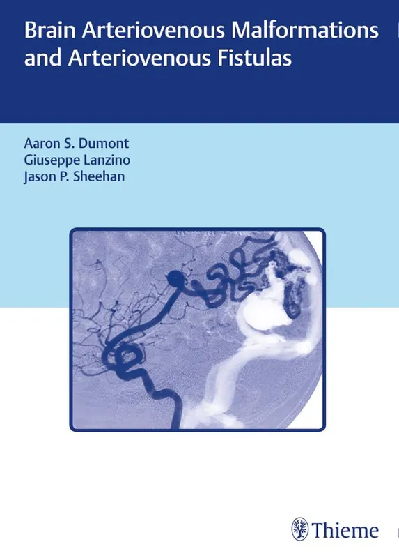 Fri frakt Brain Arteriovenous Malformations and Arteriovenous Fistulas | 0:e upplagan