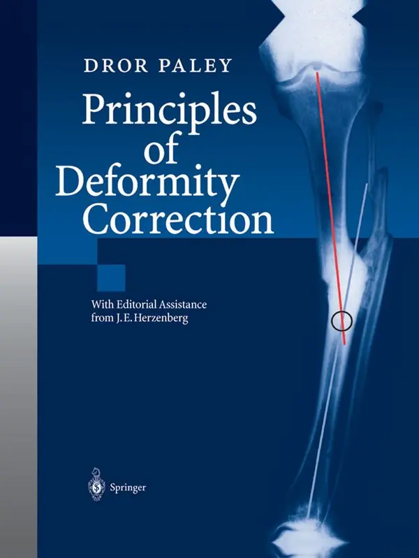 Beställ idag Principles of Deformity Correction | 1:a upplagan